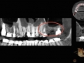 dental CT scan sinus lift graft kazemi oral surgery