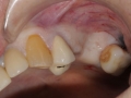 missing teeth sinus and ridge defect