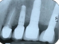 sinus lift bone graft implants final x-ray
