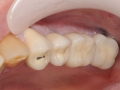 sinus lift bone graft kazemi final implant crowns