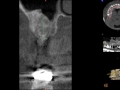 sinus lift bone graft kazemi oral surgery post op xray