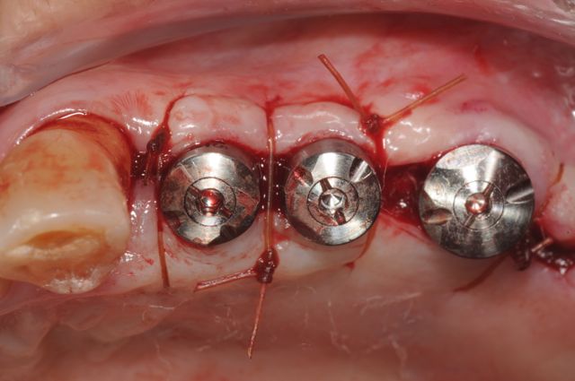 dental implants after grafting