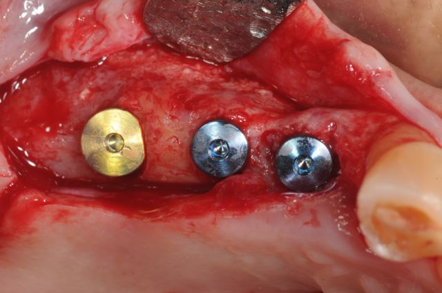 dental implants to replace missing teeth