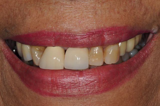 final implant crowns smile