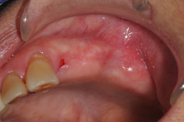 missing teeth after extractions copy
