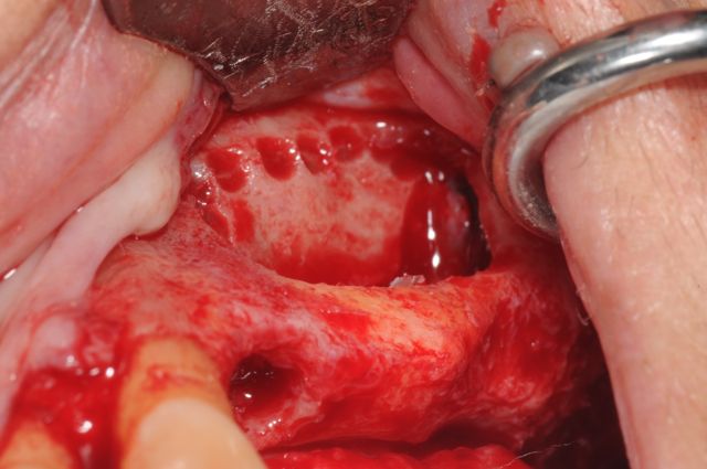 sinus lift bone graft oral surgeon