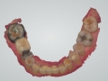 Fink- lower optical scan 3-shape copy