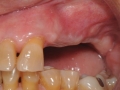 Missing teeth after bone graft copy
