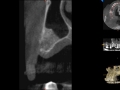cbct after bone graft copy