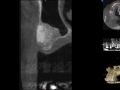 cbct after bone graft with sinus lift copy