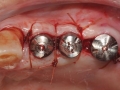 dental implants after grafting