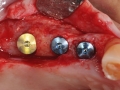 dental implants to replace missing teeth