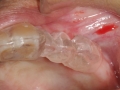 dentla imlant surgical guide