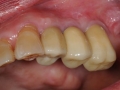 final implant crowns 3