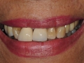 final implant crowns smile