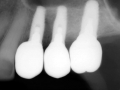 fink - final implant supported crowns