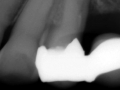 fink tooth with decay and gum disease copy