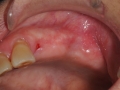 missing teeth after extractions copy