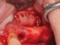 sinus lift bone graft oral surgeon