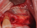 sinus lift bone graft