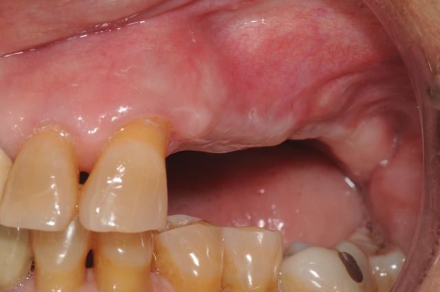 Missing teeth after bone graft