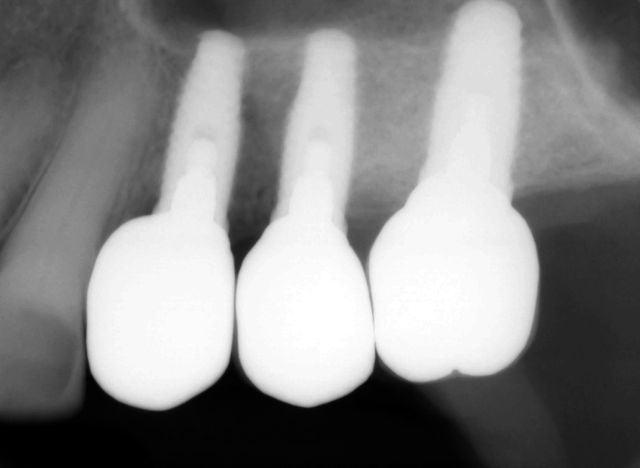 fink - final implant supported crowns copy