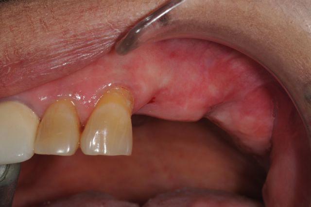 missing upper teeth after extraction