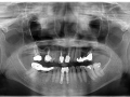 Fink- decayed tooth with gum disease