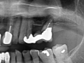 Fink- pre teeth extraction panorex