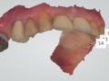 Fink upper optical scan 3-shape