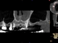 cbct missing bone due to sinus