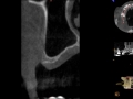 cbct no bone height for implants