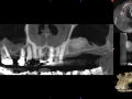 cbct pan after bone graft