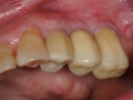 final implant crowns 3 copy