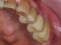 final implant crowns 4
