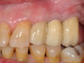 final implant crowns bite 2