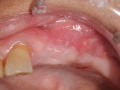 fink- after bone graft