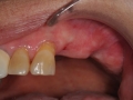 missing upper teeth after extraction
