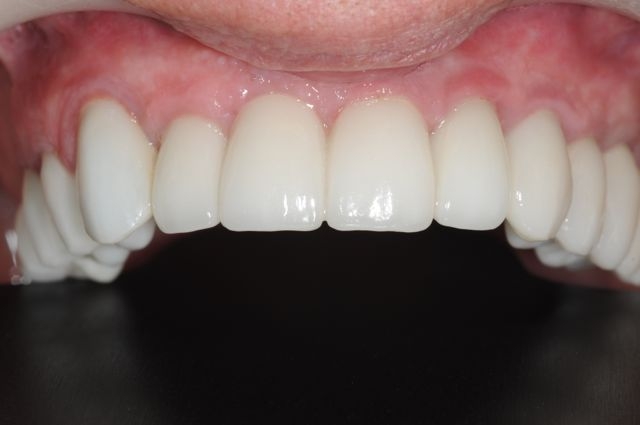 dental implants with fixed bridge- implant dentist bethesda