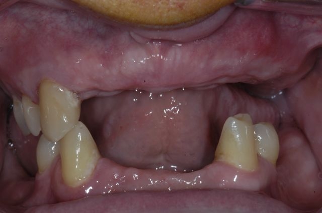 dental implants- missing teeth
