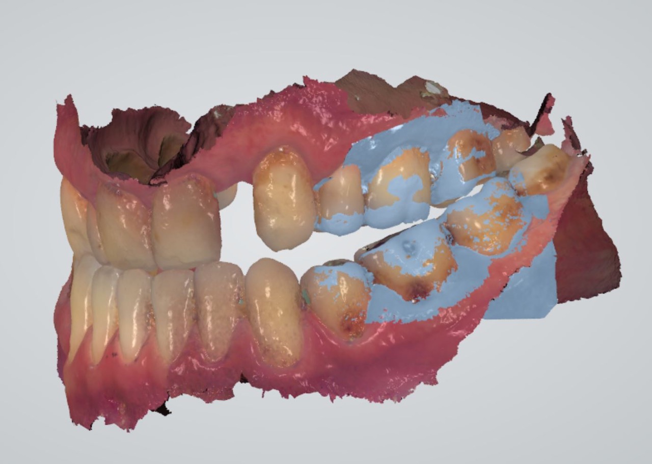 3 shape digital scan impression of dental implant kazemi oral surgery bethesda