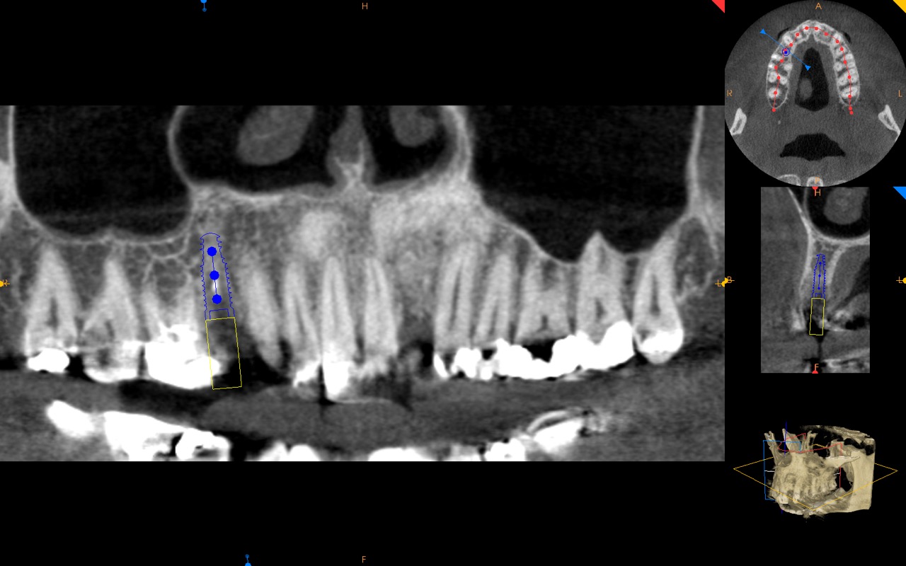 cbct of extraction site with grafting after healing kazemi oral surgery bethesda
