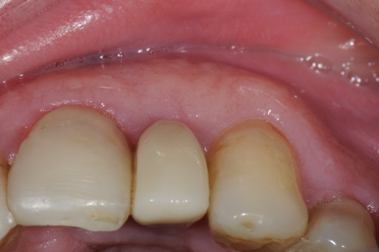 lateral incisor dental implant with customized abutment and crown restoration kazemi oral surgery bethesda
