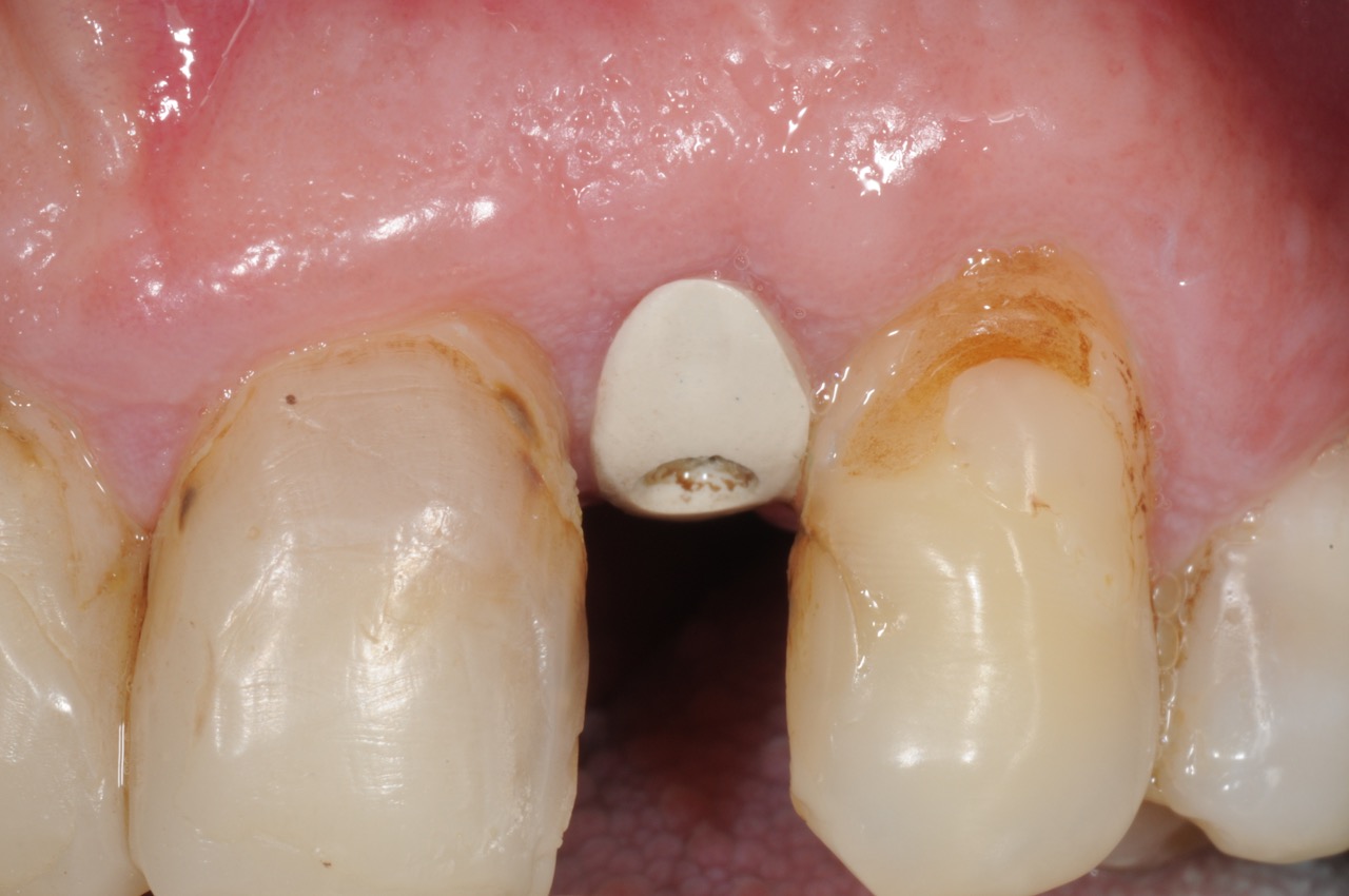 lateral incisor dental implant with customized healing abutment- healed kazemi oral surgery bethesda