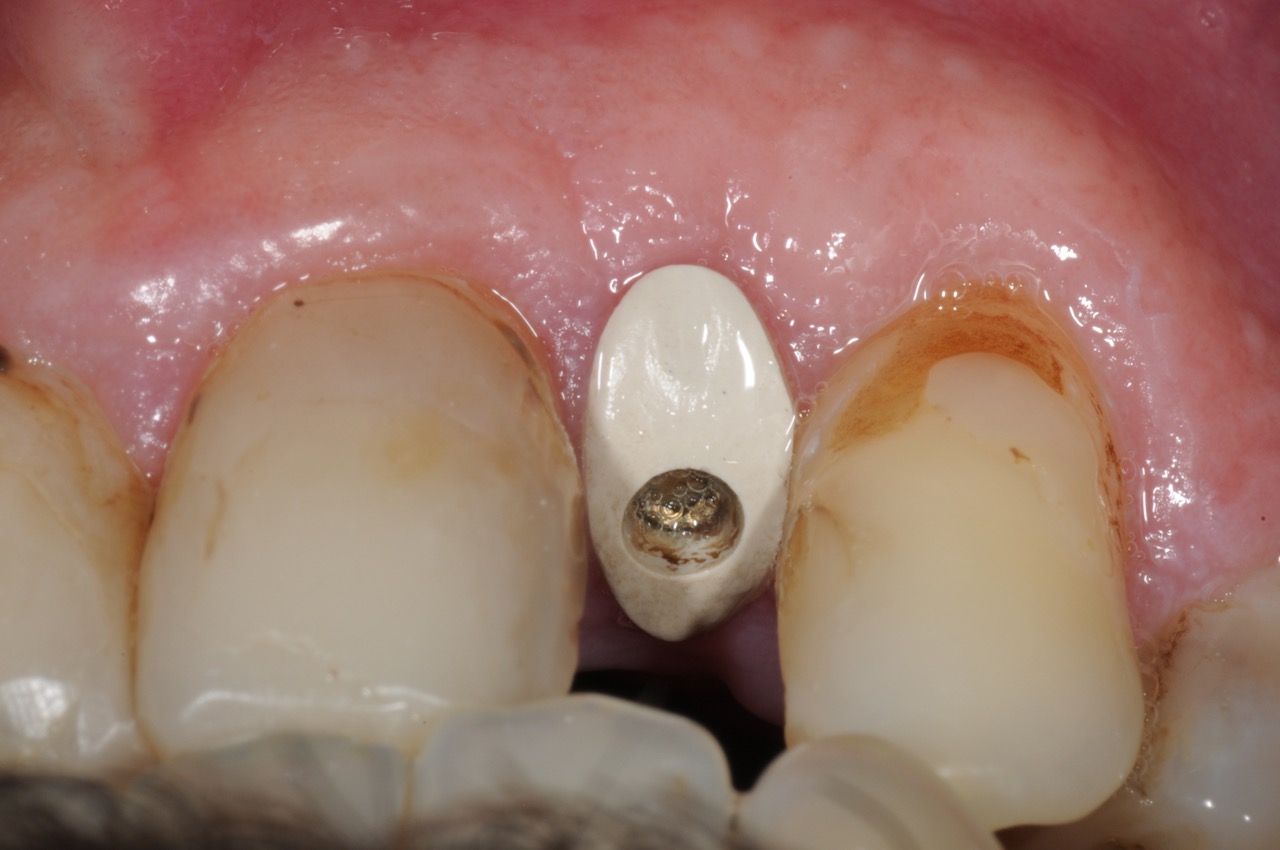 lateral incisor dental implant with customized healing abutment- healed occlusal kazemi oral surgery bethesda