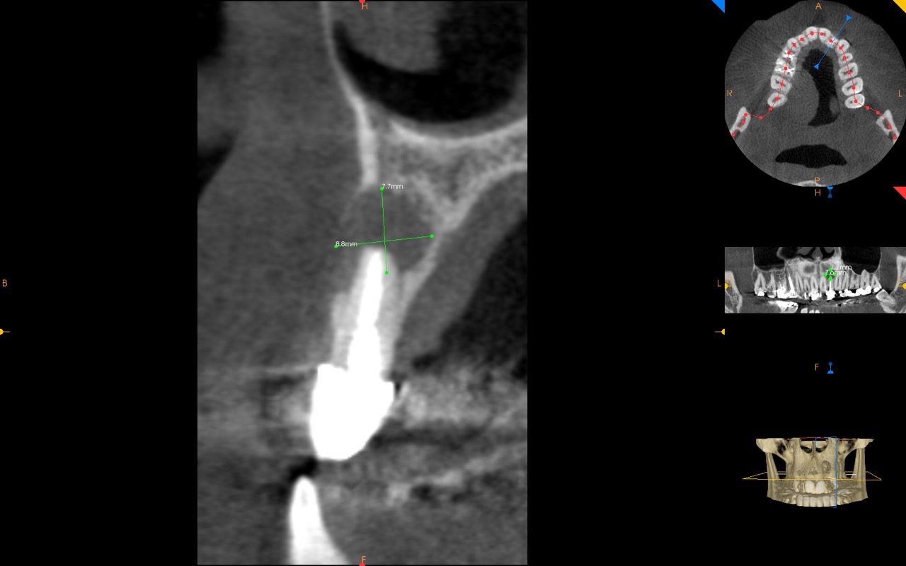 lateral incisor with cyst and bone loss CBCT kazemi oral surgery bethesda