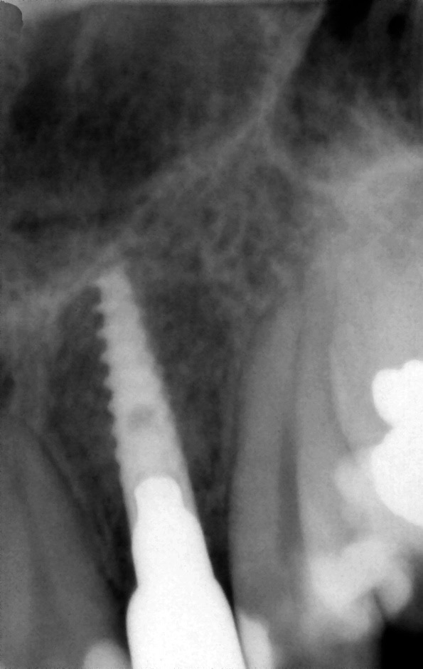 ritter dental implant 3.0 narrrow diameter final restoration- kazemi oral surgery bethesda