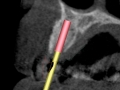 3-d computer assisted planning for implant lateral incisor kazemi oral surgery bethesda