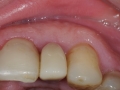 lateral incisor dental implant with customized abutment and crown restoration kazemi oral surgery bethesda
