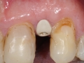 lateral incisor dental implant with customized healing abutment- healed kazemi oral surgery bethesda